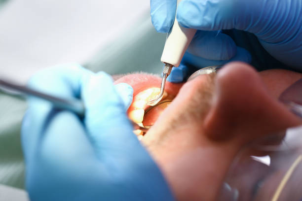 Best Emergency Dental Care for Broken or Chipped Teeth in Rogers, MN